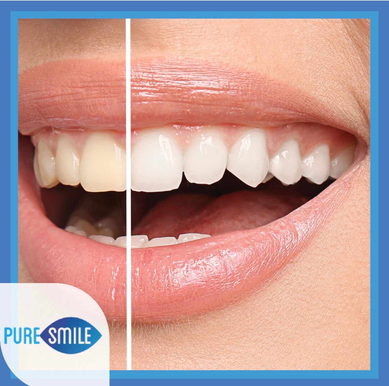 Teeth Whitening Starter Pack