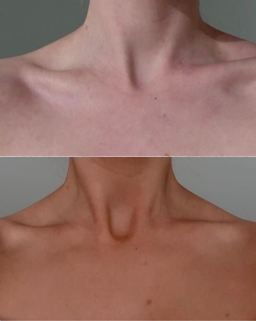Before and after result on the neck and décolletage showing a more even skin tone using Ms. Lova 1 hours express tanning mousse no.2 dark.